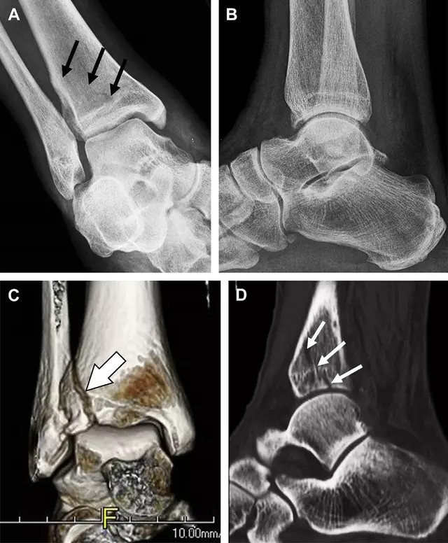 牢記易漏診的7種踝部骨折