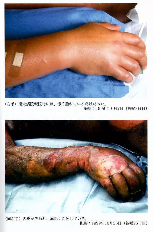 史上最痛苦死亡:此日本人遭到致命核辐射,被强行救"活"了83天