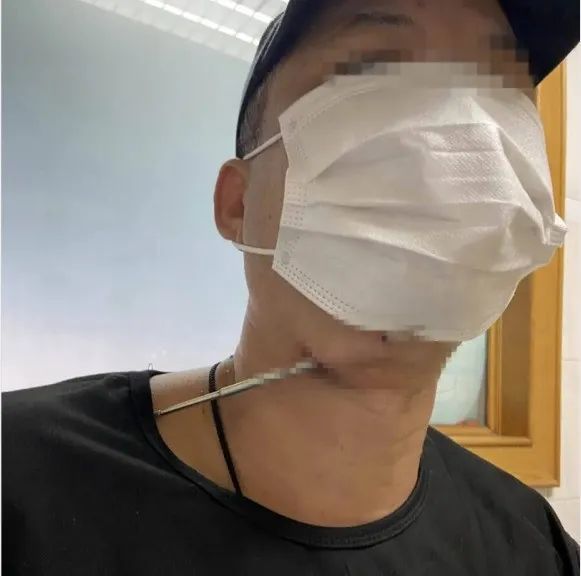 离大动脉不到1厘米!