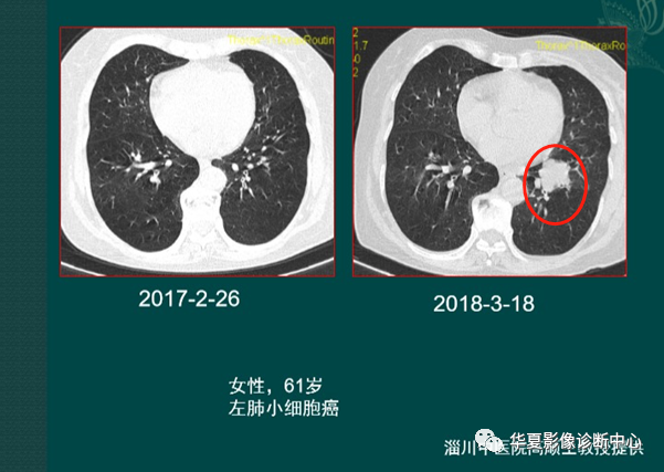 Ct片怎样分辨小细胞肺癌 腾讯新闻