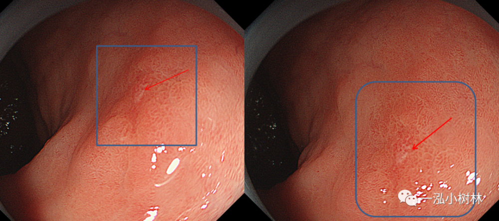 早期胃癌病例分享内镜集锦