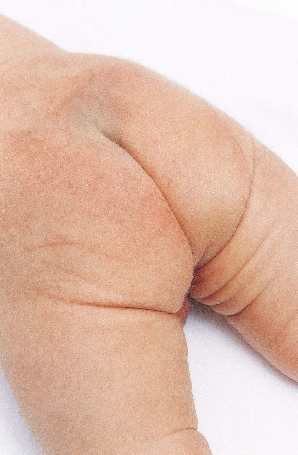 医生:蒙古斑了解一下_腾讯新闻