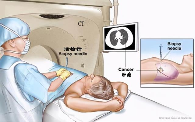 肺穿刺活检,是一种诊断方法和手段,主要用于明确一些肺部周围型的肿块