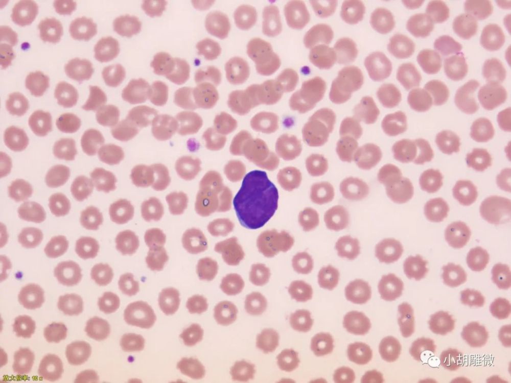 傻傻分不清的淋巴细胞