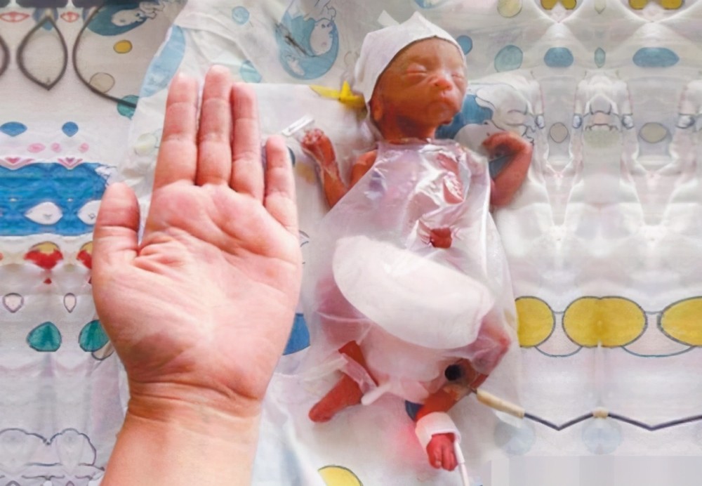 宝宝早产概率逐年升高尤其是高龄多胞胎产妇更应该多注意