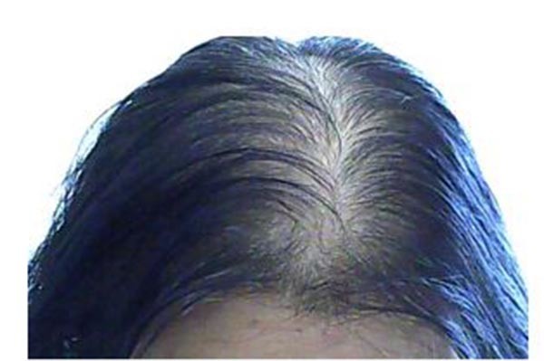 女性脱发怎么治疗止脱生发的好方法