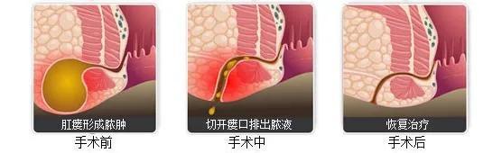 便血是上火还是痔疮武汉国医堂消化科医生可不止这些