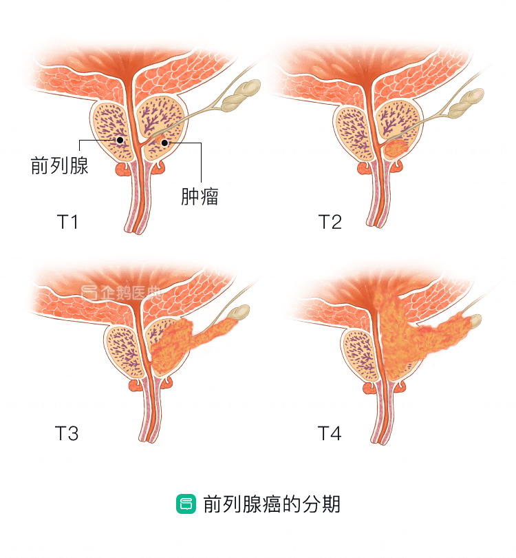 前列腺癌位置图图片
