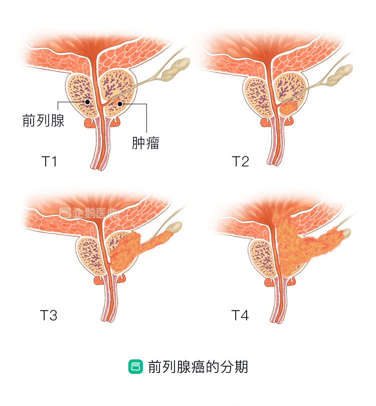 前列腺癌是打飞机太多引起的 答案你绝对想不到 全网搜