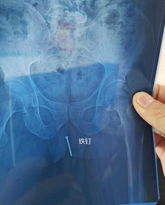 泸州合江男子竟将5厘米长生锈钉子塞进尿道