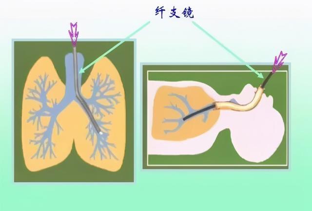 哪些情况要做纤支镜?做纤支镜难受吗?