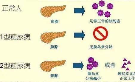 減少 糖尿病 体重