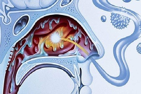 濰坊耳鼻喉醫院:那種真菌性鼻竇炎最危險