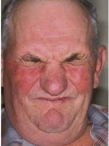 挤眉弄眼歪鼻斜嘴梅杰综合征如何治疗