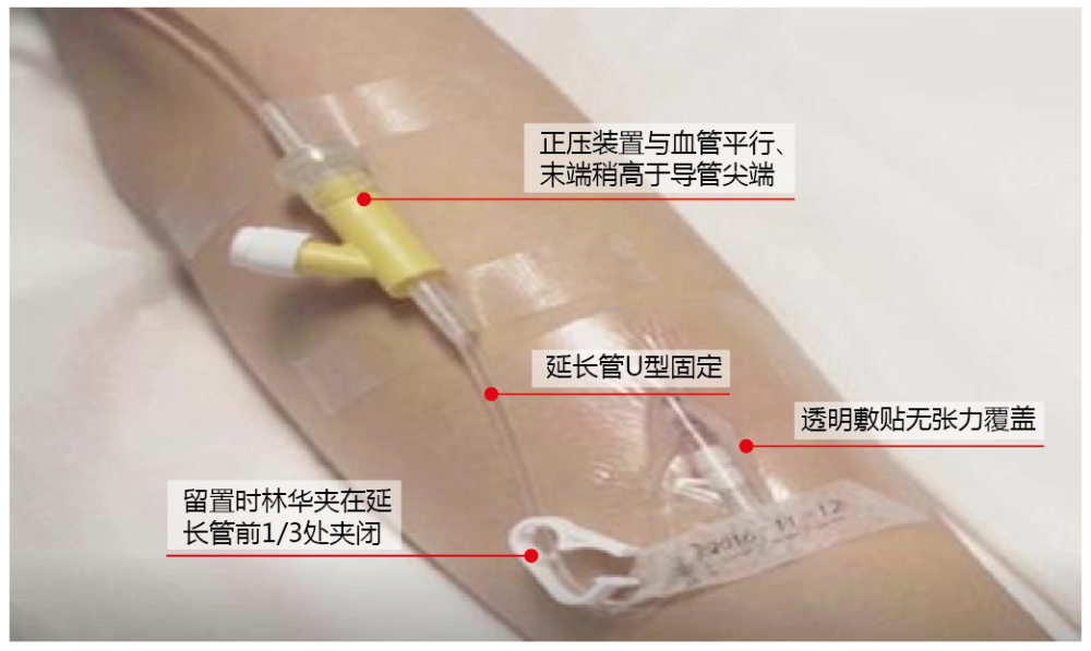 差异,使用带有正压接头留置针组回血发生率明显低于肝素帽留置针组[3]