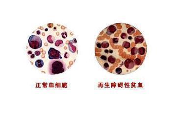 而白血病是恶性的血液疾病,白血病指的是骨髓这个造血工厂生产出了