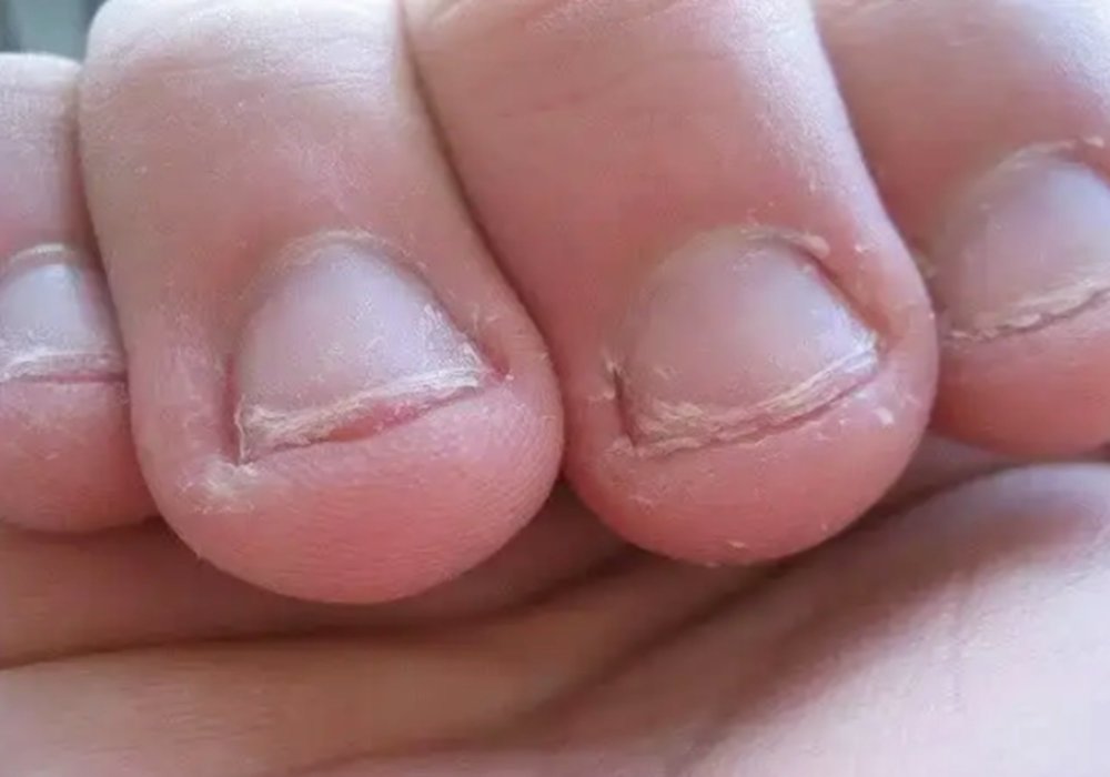 孩子咬指甲的毛病可能不是缺营养两种心理诱因家长需自查