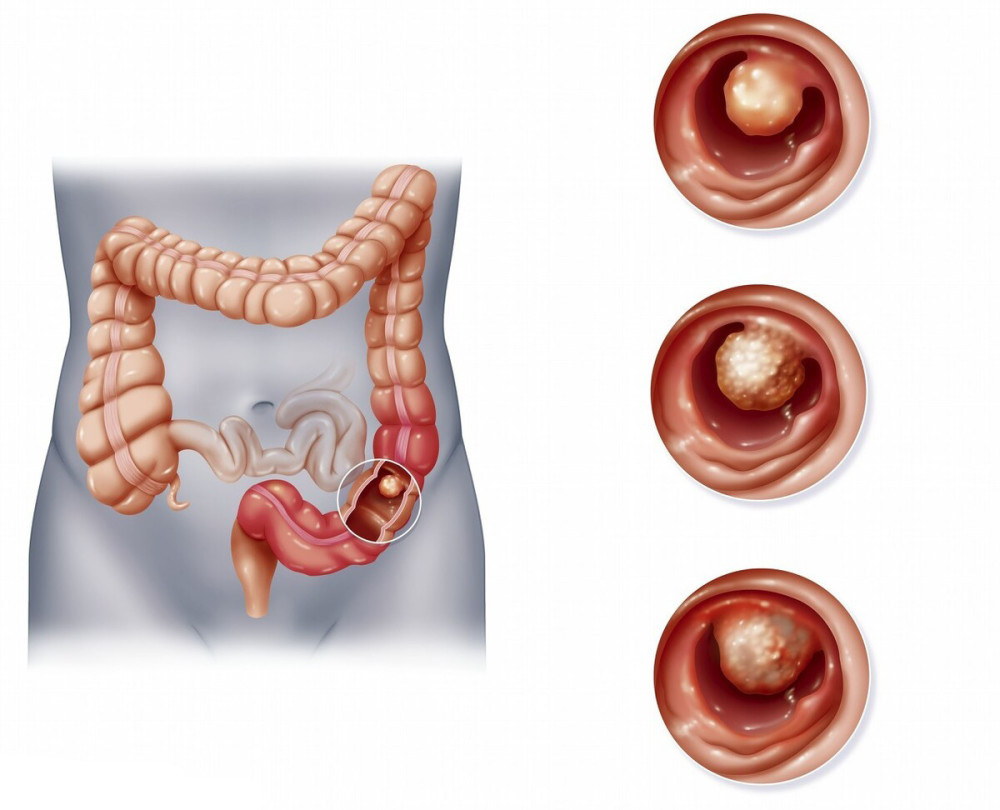 直肠癌早期症状和前兆图片