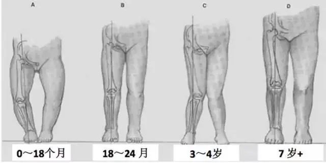 寶寶腿不直x型腿o型腿警惕你可能陷入了腿型誤區