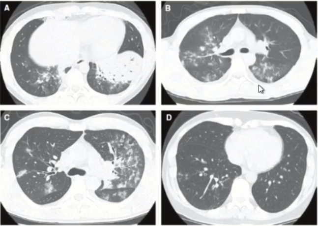 支原体肺炎诊治的这些问题你是不是也遇到过│cts2020