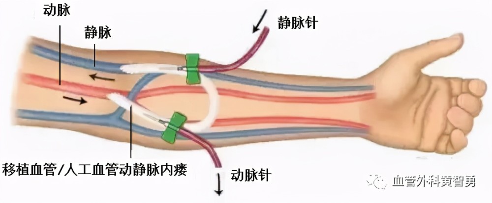 总之,内瘘其实是把动脉血引到浅表血管上,以后在浅表血管上打针建立