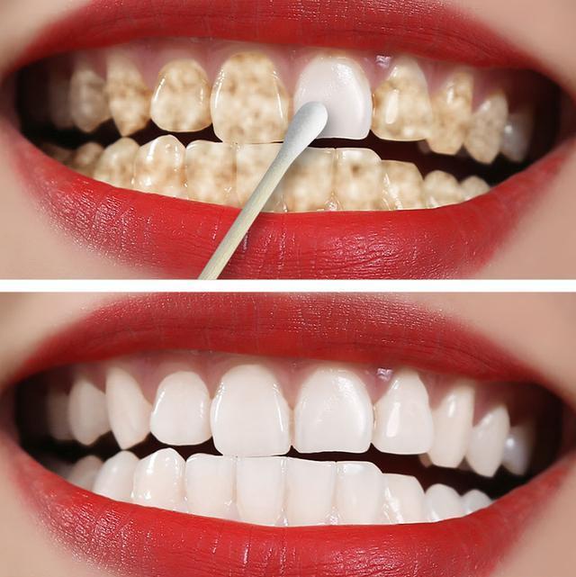 瓷贴面效果真的挺不错的