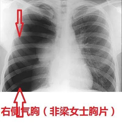 而现在胸片也看到左侧没有肺纹理,肺脏被压缩了,那就100%是气胸了