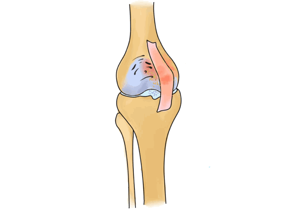 膝盖不同部位疼是什么病骨科专家一表教你辨别