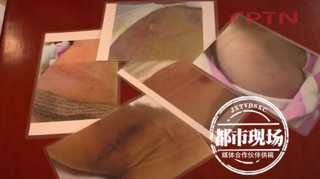 女子隆胸失败,身体出现不适,整形机构居然"一问三不知"