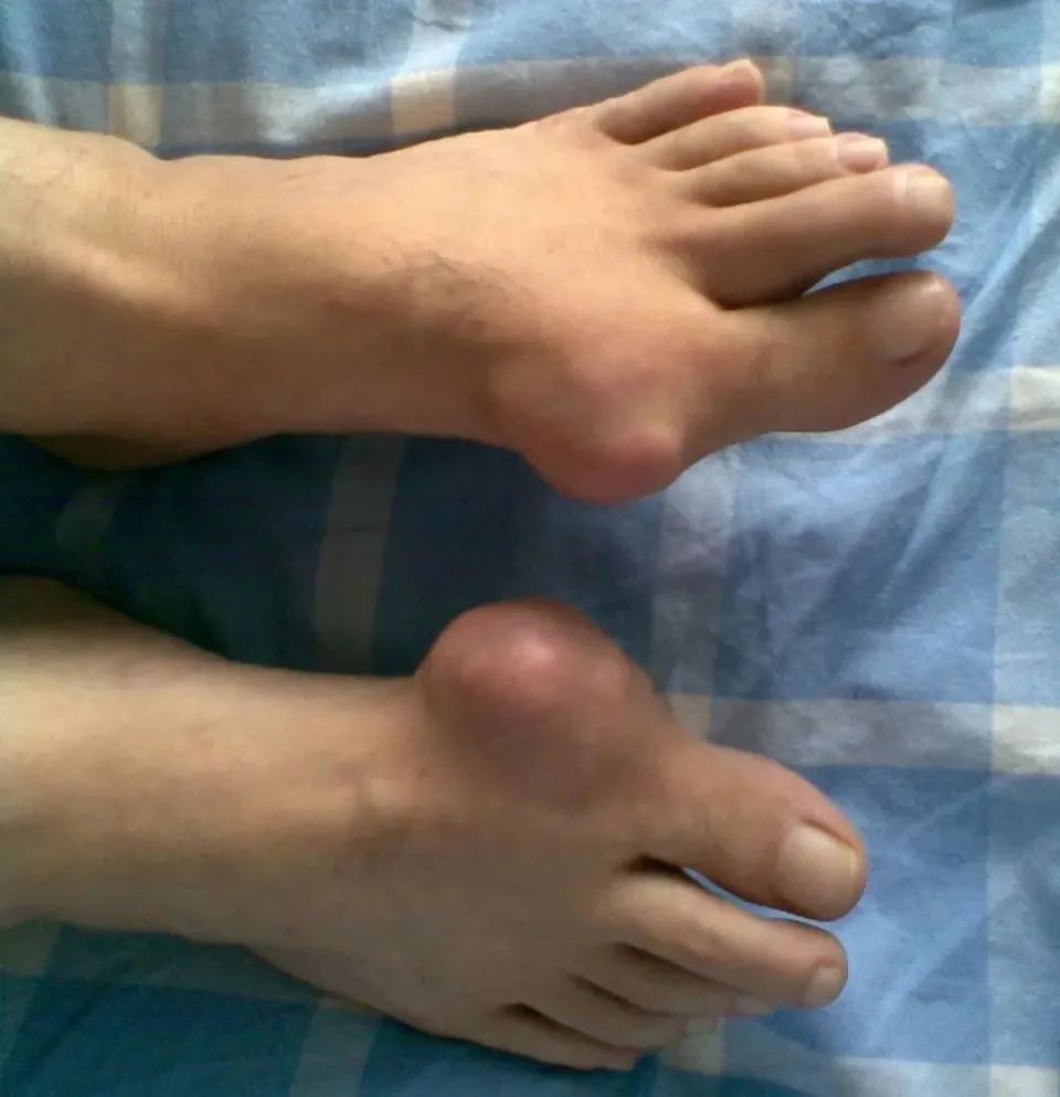 痛风的人,这三种"水"不宜多喝,会快速升高尿酸,再喜欢也要忍住