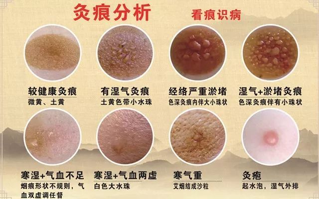 看艾灸灸痕艾灸后的灸痕水泡可判断体内湿气严重性