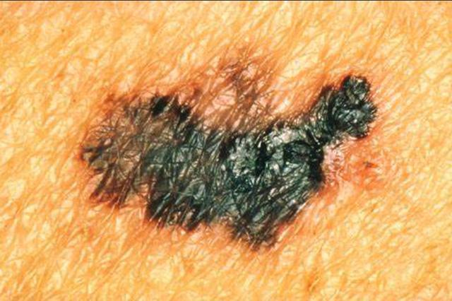 比如骨科中常用的 塞来昔布,这种药物也可以有效地减少疼痛,并且减少