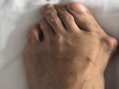 广东这位阿姨跳完广场舞,脚趾竟痛到不能穿鞋!这个病专害女人