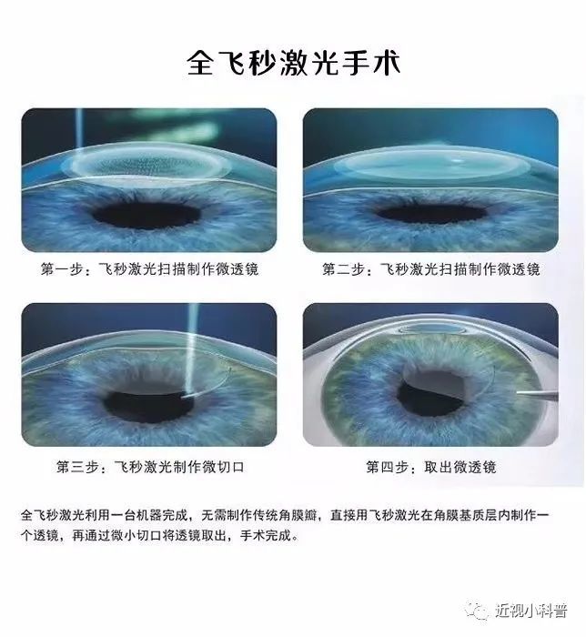 21年参军做哪种手术方式最好 眼科专家推荐 腾讯新闻