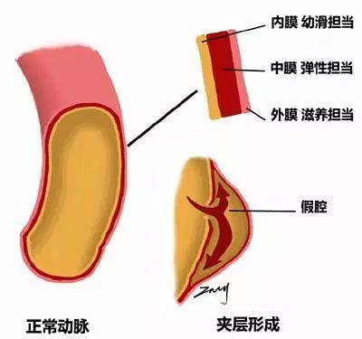 并发症|47岁男子，背痛一天，骤然离世，医生措手不及，这病真的太凶险