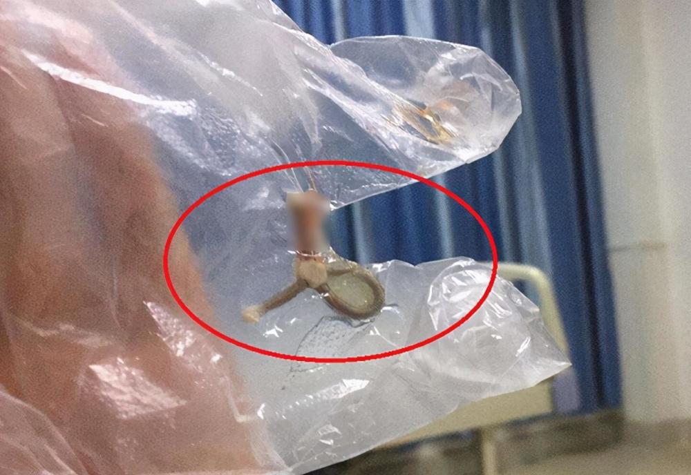 最早一批上环的人,现在还好吗?节育环造成的影响,女人不可不知