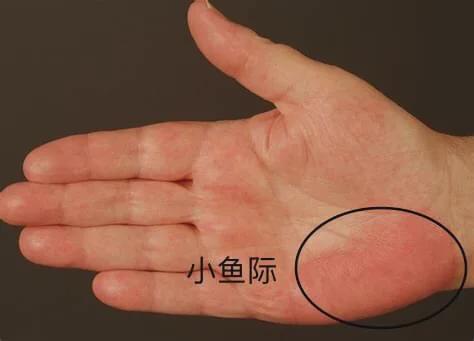 肝掌肝掌的出现跟蜘蛛痣的原理是一样的,典型的表现在手掌大,小鱼际