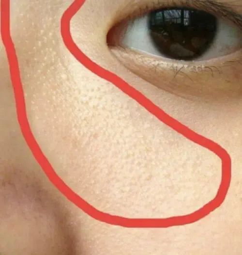 鼻子两侧有鸡皮肤怎么祛除(鼻子周围像鸡皮一样的东西怎么去除)