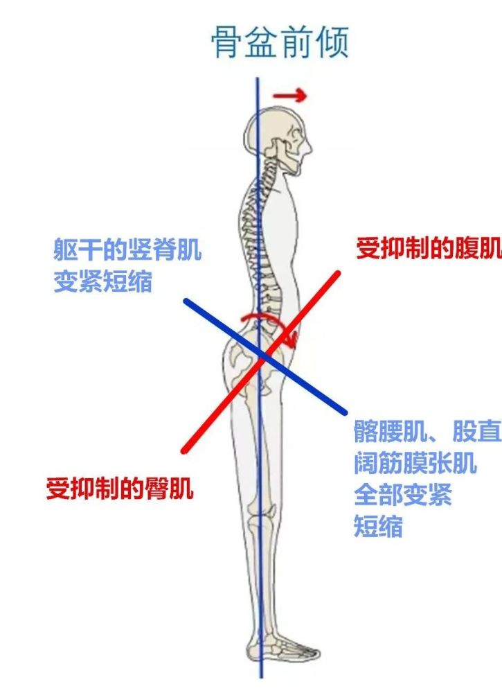 骨盆前倾的四大危害 Qtc Care