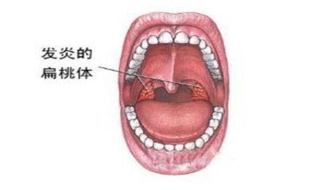 慢性喉咙痛吃什么药效果最好_慢性喉咙痛发炎怎么办_新冠慢性咽炎嗓子巨疼一招自愈