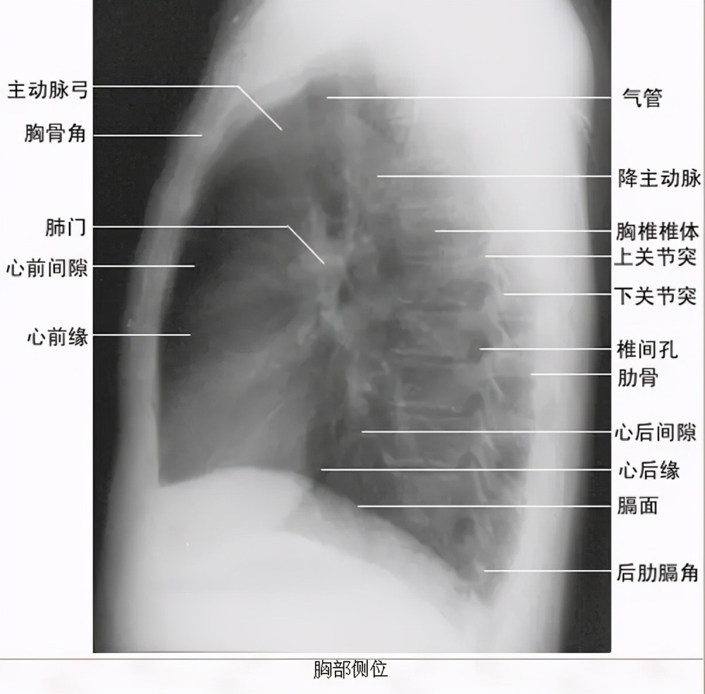 胸部侧位片上图为正常胸部后前位片临床拍标准的胸部正位片其实是