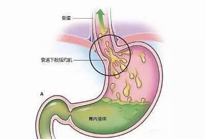 你知道胆结石形成的原因是什么吗？我们要知道两者的比例关系胆结石胆汁