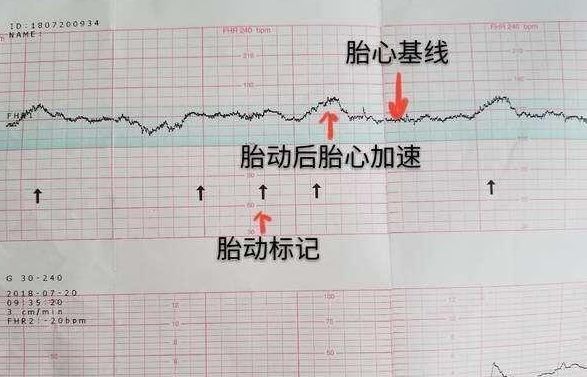 孕三十八周每天听一次胎心都合格能说明胎儿没事吗?