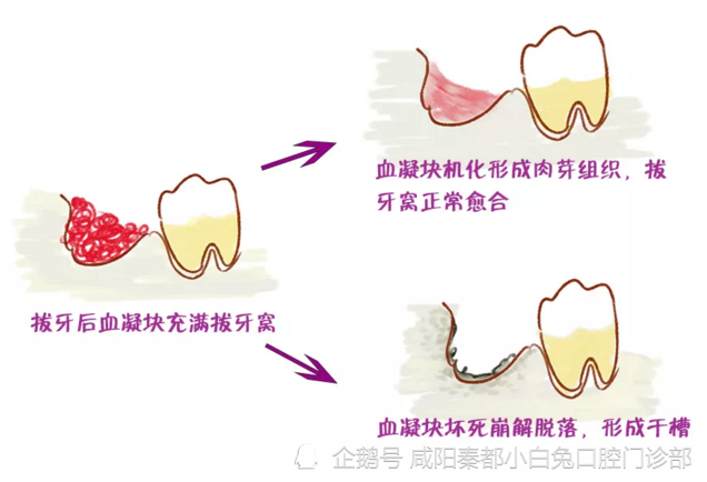 拔完智齿不出血或血凝块脱落 可能会怎样 智齿 干槽症 血凝块