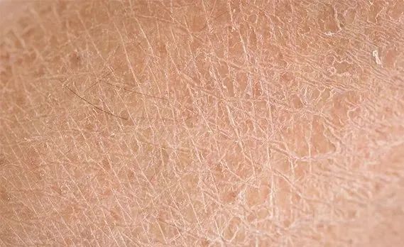 天气转凉 皮肤干燥起鳞屑 是鱼鳞病吗?