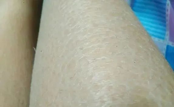 天气转凉皮肤干燥起鳞屑是鱼鳞病吗 鱼鳞病 皮肤干燥