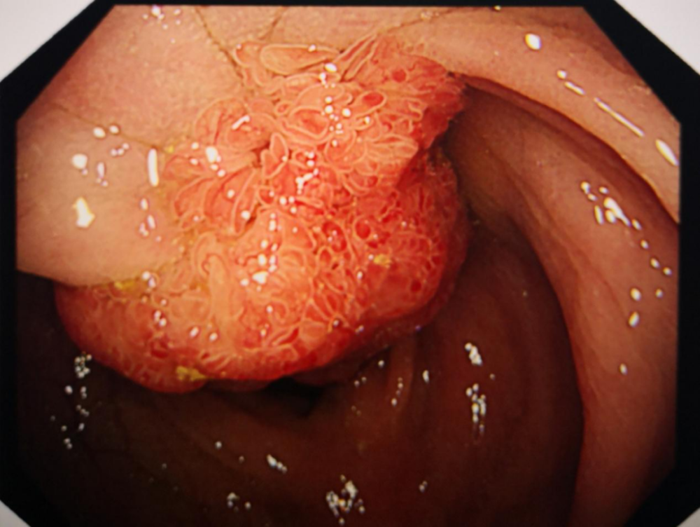 病例结肠多发性息肉分次切除内镜下分片黏膜切除术切除巨大息肉一枚