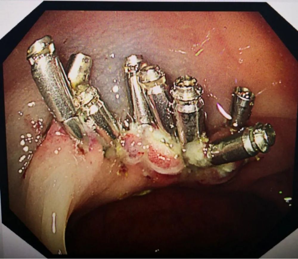 巨大息肉epmr报告图8  距肛缘50cm绒毛状—管状腺瘤,山田iv型,ppi型 