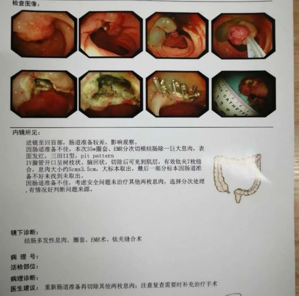 圖7 巨大息肉epmr報告圖8 距肛緣50cm絨毛狀—管狀腺瘤,山田iv型