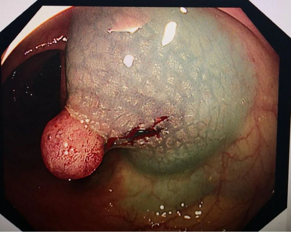 病例结肠多发性息肉分次切除内镜下分片黏膜切除术切除巨大息肉一枚
